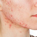 Mụn nang là gì? Có tự hết không? 5 Cách trị mụn u nang tại nhà