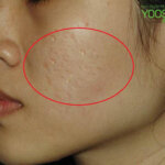 Sẹo mụn: Nguyên nhân, phân loại và 7 cách điều trị hiệu quả