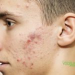 8+ cách trị mụn cho nam đơn giản ngay tại nhà!