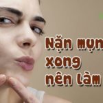 Nặn mụn xong nên làm gì? 7 “Bí Kíp” Để da không bị thâm, sẹo