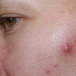 [Tìm hiểu] Cách nặn mụn bọc đúng cách, không để lại thâm sẹo