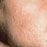 Mụn ẩn là gì ? 10+ cách trị mụn ẩn nhanh, an toàn, hiệu quả!