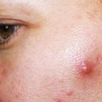 Mụn nhọt là mụn gì? 9+ cách trị mụn nhọt hiệu quả tại nhà