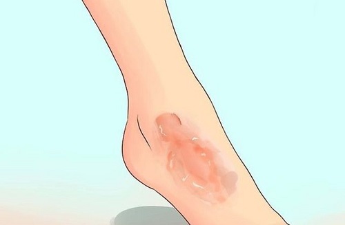 cách trị sẹo thâm ở chân