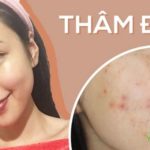 Thâm mụn là gì? Nguyên nhân & 6 cách điều trị hiệu quả