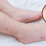 11 cách trị sẹo thâm ở chân lâu năm cấp tốc, hiệu quả, an toàn