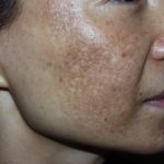 5 cách trị sẹo thâm ở mặt Hiệu Quả – An Toàn – Đơn giản tại nhà!