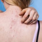 8+ cách trị thâm mụn lưng lâu năm An Toàn, Hiệu quả!