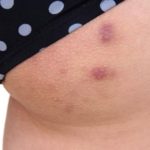 5+ Cách trị thâm mụn mông Nhanh, An toàn tại nhà!