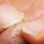 [Hướng dẫn] Cách nặn mụn đầu đen đúng cách, không để lại thâm