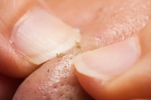 Cách nặn mụn đầu đen lâu năm
