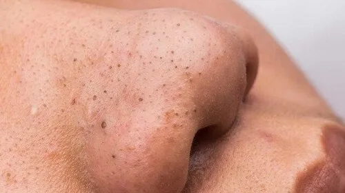 Có nên nặn mụn đầu đen không