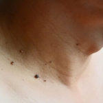 Bị mụn thịt trên cổ: Nguyên nhân và cách trị mụn thịt ở cổ tại nhà