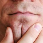 Mụn đầu trắng liti: Nguyên nhân và cách trị mụn đầu trắng tận gốc