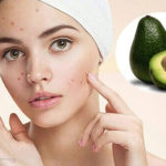 Bật mí 6 cách trị mụn bằng bơ cực kỳ đơn giản và hiệu quả