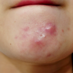 5 cách trị mụn viêm không nhân hiệu quả, được ưa thích nhất!