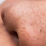 [Giải đáp] Để lâu ngày, mụn đầu đen thành nốt ruồi không?