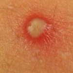 Mụn mủ là gì? Có nên nặn không? Cách trị mụn mủ trắng hiệu quả nhất