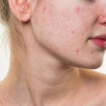 Mụn nội tiết là gì? Nguyên nhân và cách trị mụn nội tiết dứt điểm