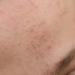 Mụn ở Trán: Nguyên nhân – Cách điều trị và ngăn ngừa hiệu quả nhất!