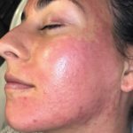 Chia sẻ cách chăm sóc da sau lăn kim tại nhà an toàn, chuẩn nhất