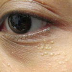 7 Cách dùng lá tía tô trị mụn thịt ở mắt và cổ an toàn, hiệu quả nhất