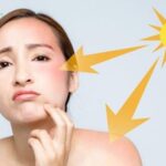 Da mụn có nên dùng kem chống nắng? Nên bôi thế nào?