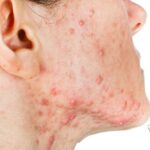 Mụn mạch lươn là gì? Hình ảnh, Cách điều trị hiệu quả!