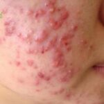 Mụn ăn luồng: Nguyên nhân, biểu hiện và cách điều trị hiệu quả