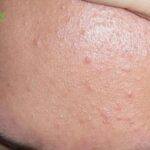 Mụn sẩn là gì? Cách trị mụn sần sùi dưới da hiệu quả!