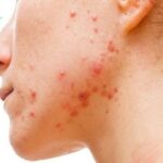 Mụn trứng cá bao lâu thì chín? Cách nặn an toàn, không bị sẹo!