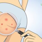 Mụn nhọt ở mông: Nguyên nhân, 9 cách chữa trị tại nhà hiệu quả!