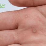 Mụn cóc có lây không? Lây qua những đường nào?